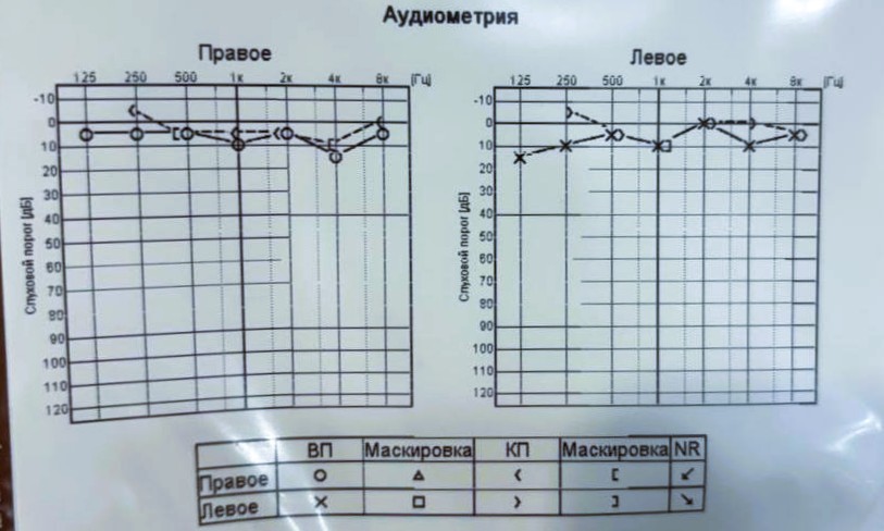 Аудиометрия