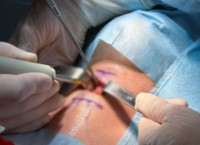 Операции на голосовых связках